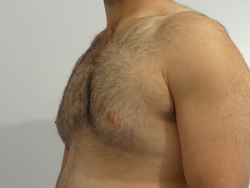 Gynecomastia Before & After Gallery - Patient 152899 - Image 3