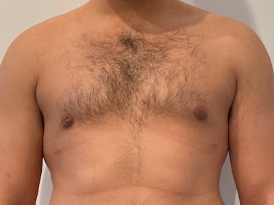 Gynecomastia Before & After Gallery - Patient 152702 - Image 2