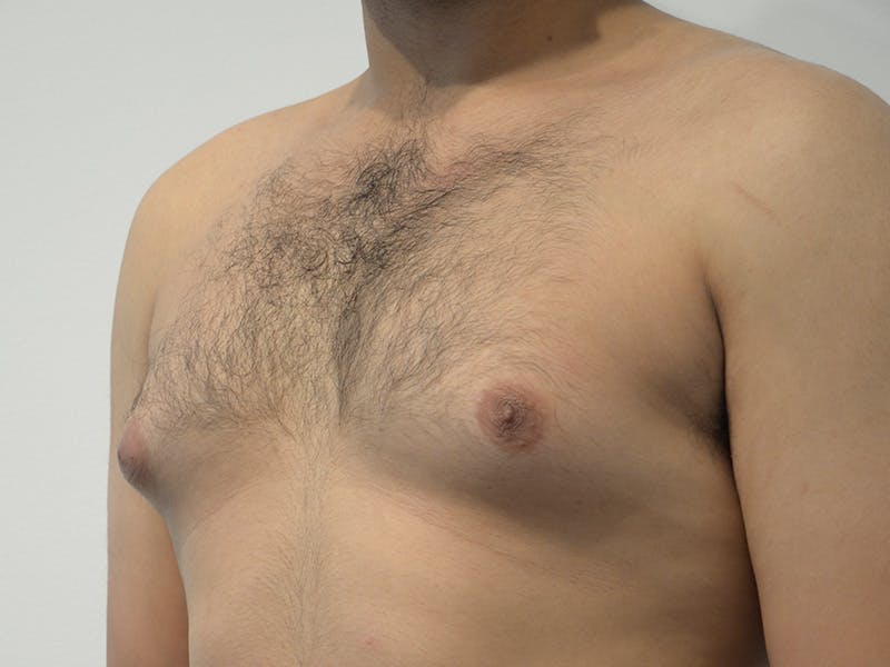 Gynecomastia Before & After Gallery - Patient 152702 - Image 3
