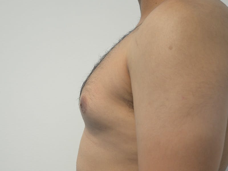 Gynecomastia Before & After Gallery - Patient 152702 - Image 5