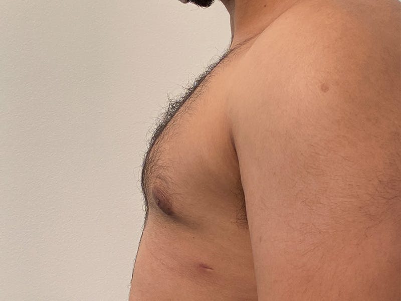 Gynecomastia Before & After Gallery - Patient 152702 - Image 6