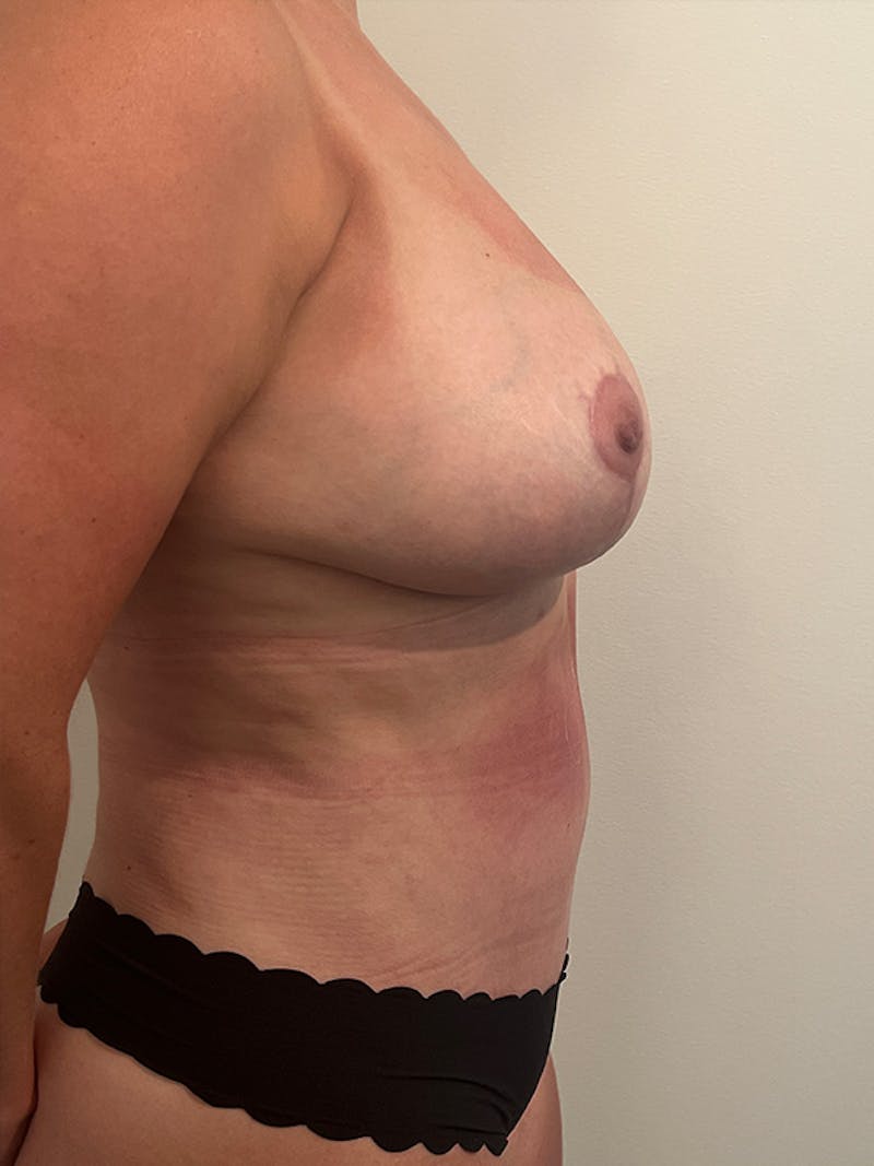 Mommy Makeover Before & After Gallery - Patient 218568 - Image 6