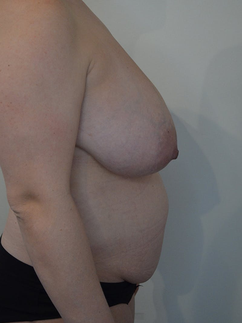 Mommy Makeover Before & After Gallery - Patient 218568 - Image 5