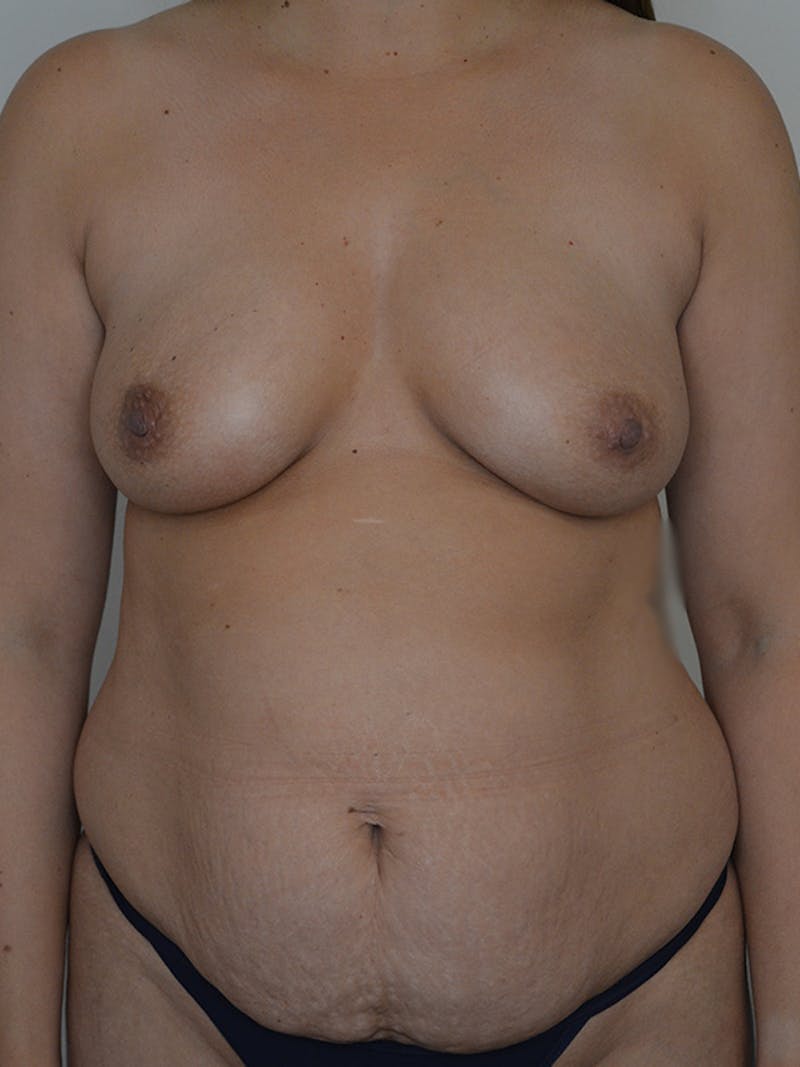 Mommy Makeover Before & After Gallery - Patient 355180 - Image 1