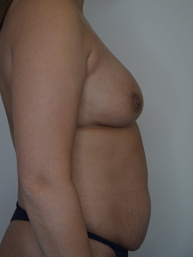 Mommy Makeover Before & After Gallery - Patient 355180 - Image 5