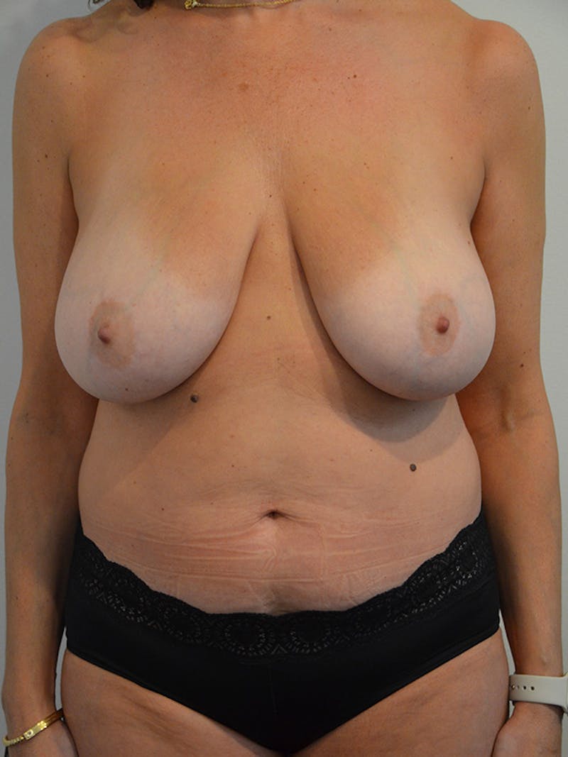 Mommy Makeover Before & After Gallery - Patient 105832 - Image 1