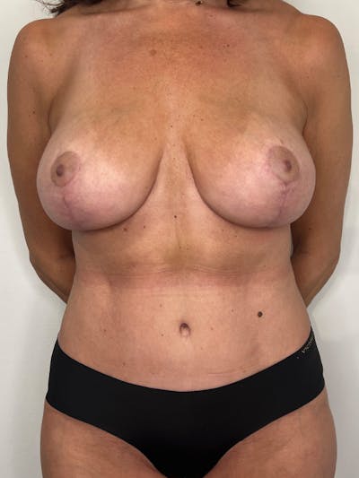 Mommy Makeover Before & After Gallery - Patient 105832 - Image 2