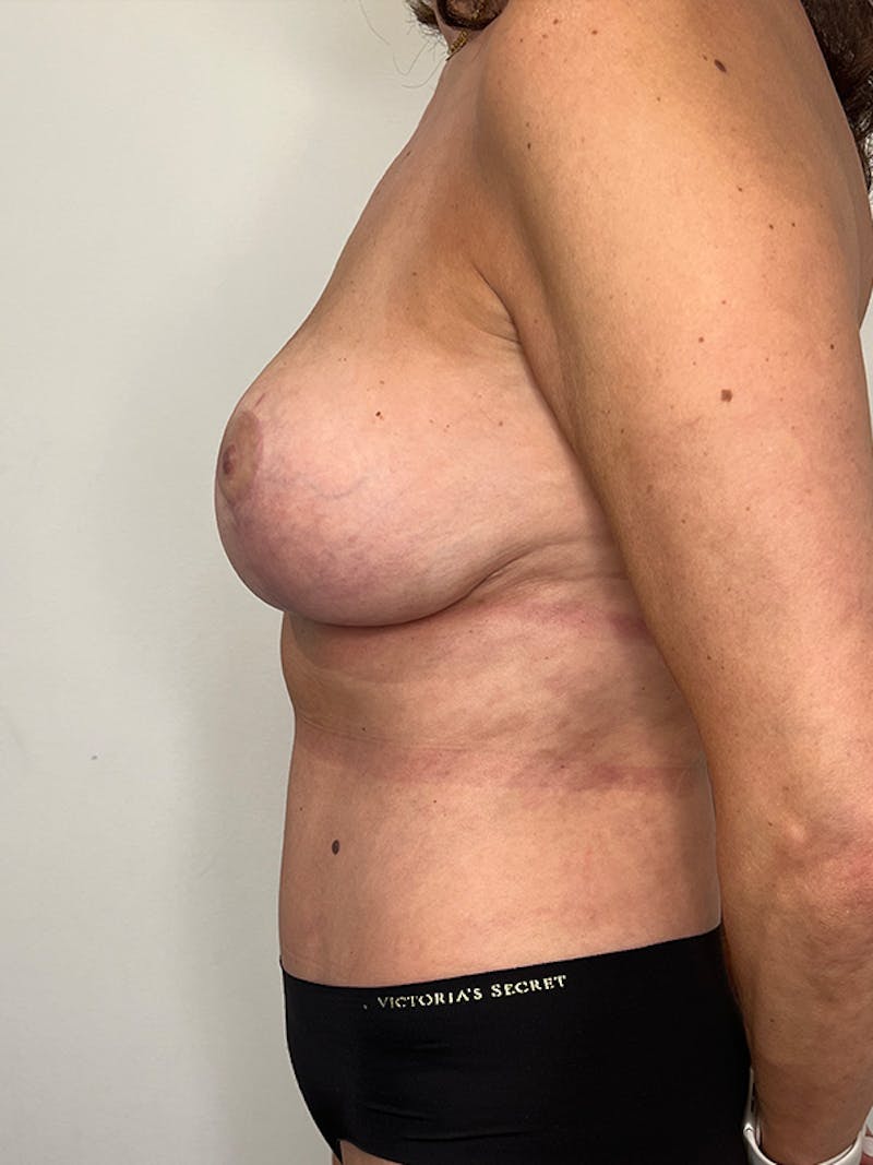 Mommy Makeover Before & After Gallery - Patient 105832 - Image 6