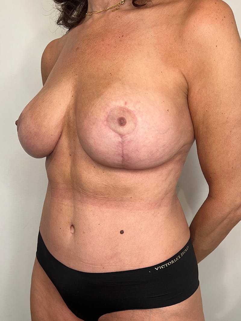 Mommy Makeover Before & After Gallery - Patient 105832 - Image 4