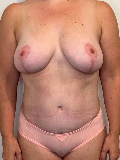 Mommy Makeover Before & After Gallery - Patient 379137 - Image 2