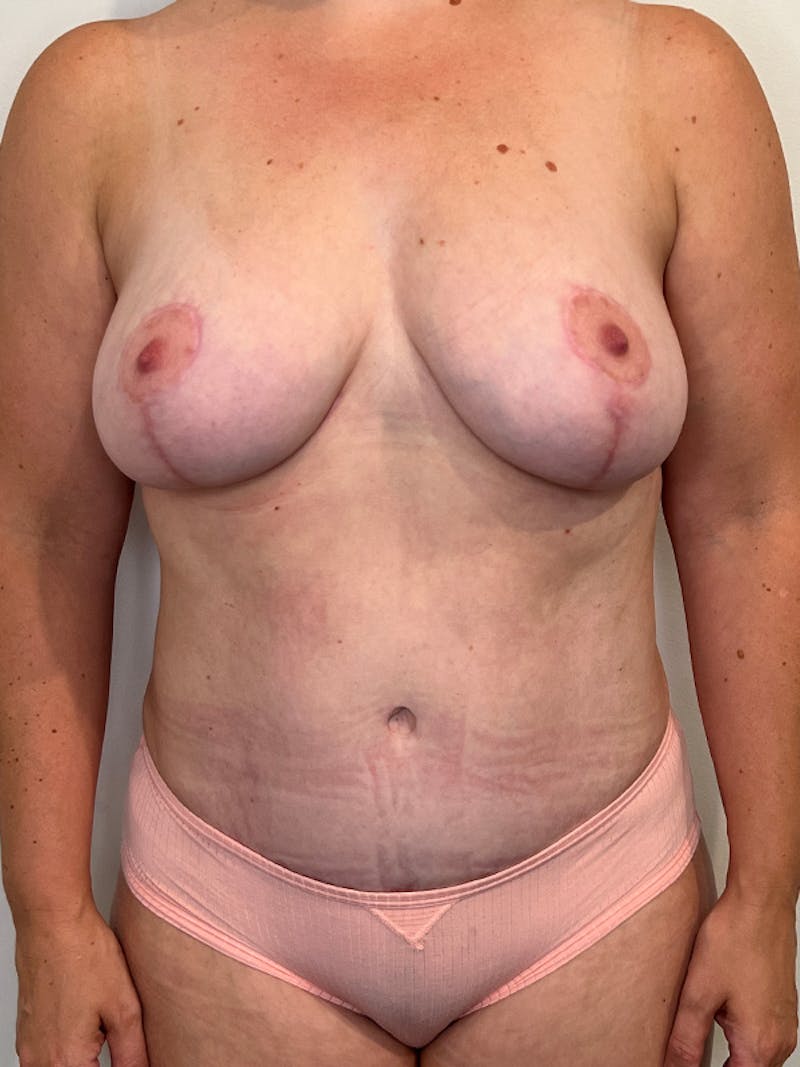 Mommy Makeover Before & After Gallery - Patient 379137 - Image 2