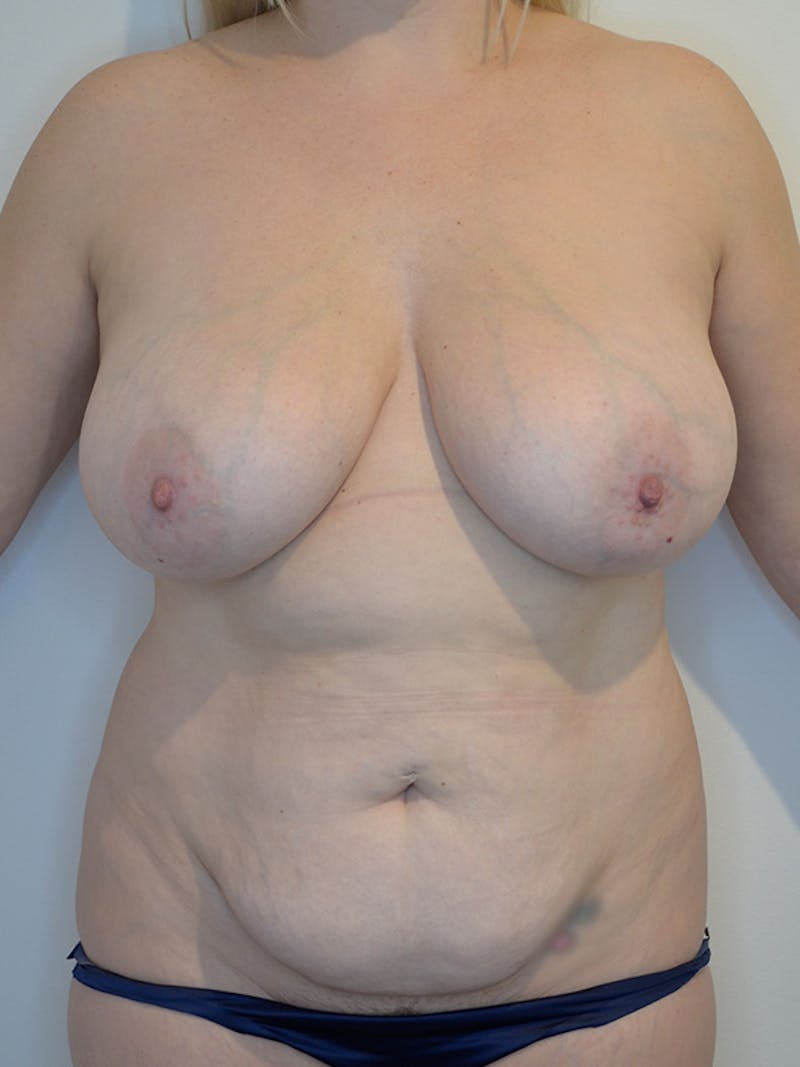 Mommy Makeover Before & After Gallery - Patient 184642 - Image 1