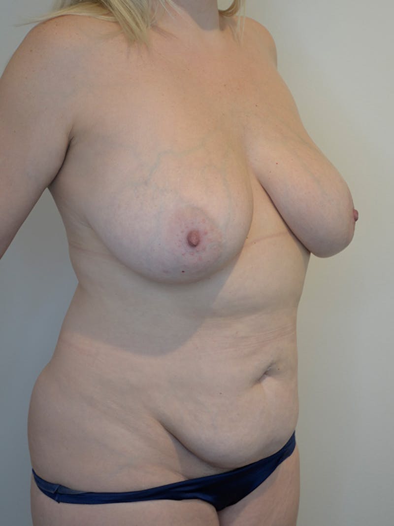 Mommy Makeover Before & After Gallery - Patient 184642 - Image 5