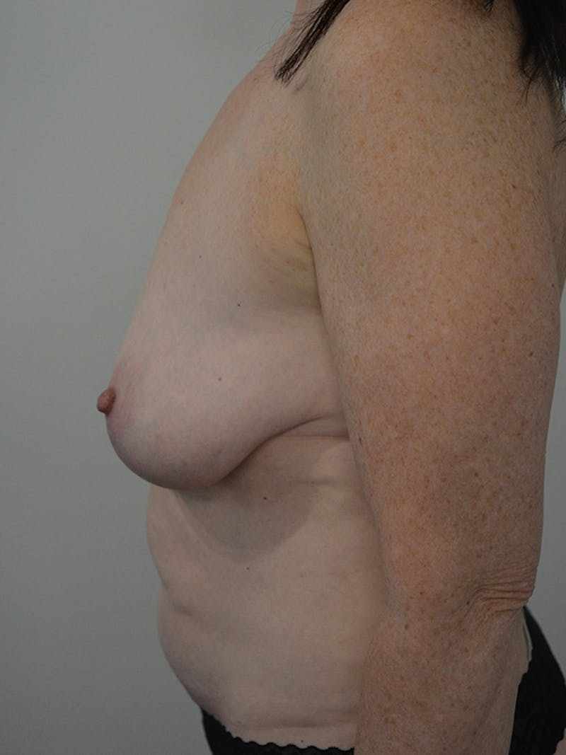 Mommy Makeover Before & After Gallery - Patient 101477 - Image 5