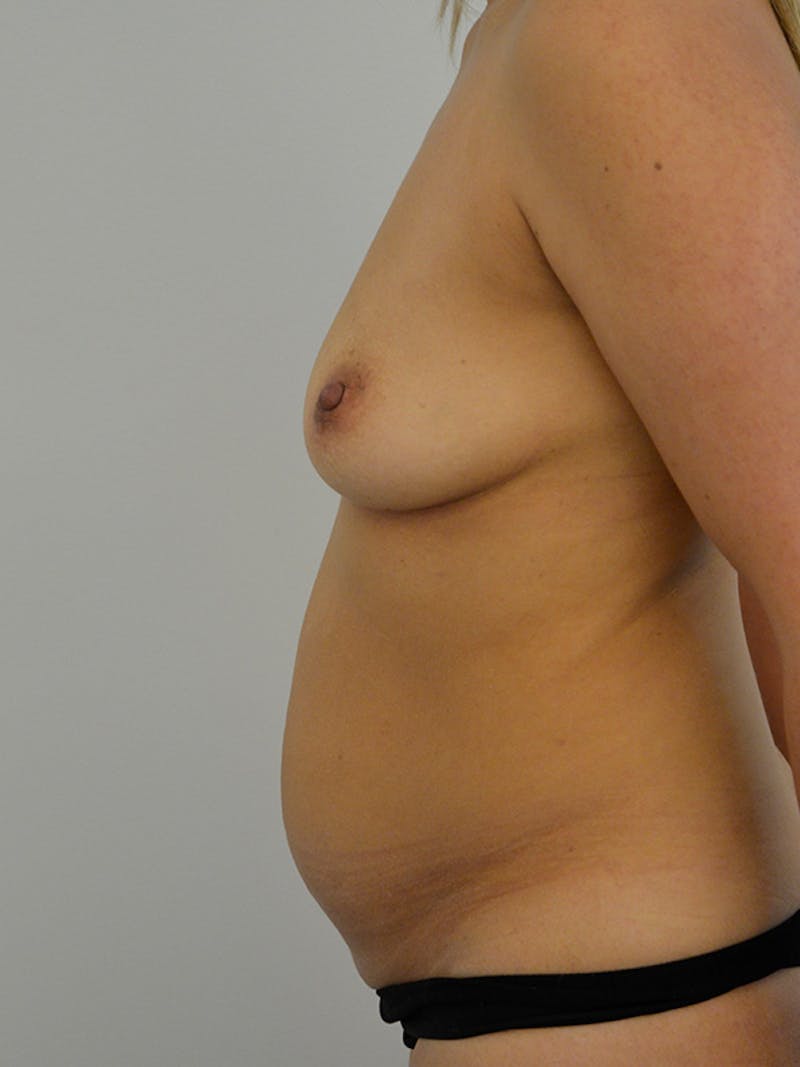 Mommy Makeover Before & After Gallery - Patient 117631 - Image 5