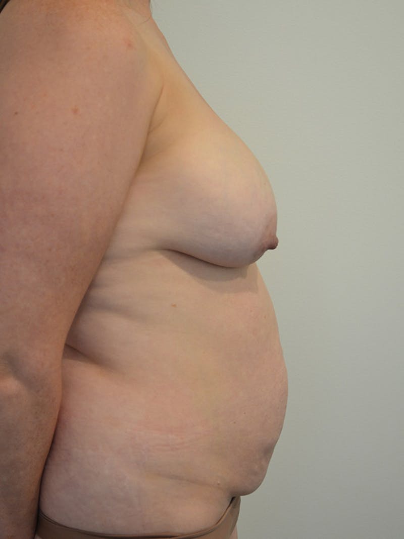 Mommy Makeover Before & After Gallery - Patient 137788 - Image 5