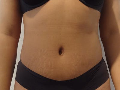 Tummy Tuck Before & After Gallery - Patient 127535 - Image 2
