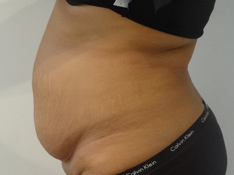 Tummy Tuck Before & After Gallery - Patient 127535 - Image 5