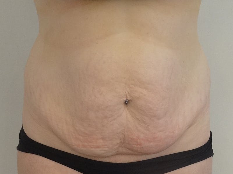 Tummy Tuck Before & After Gallery - Patient 114862 - Image 1