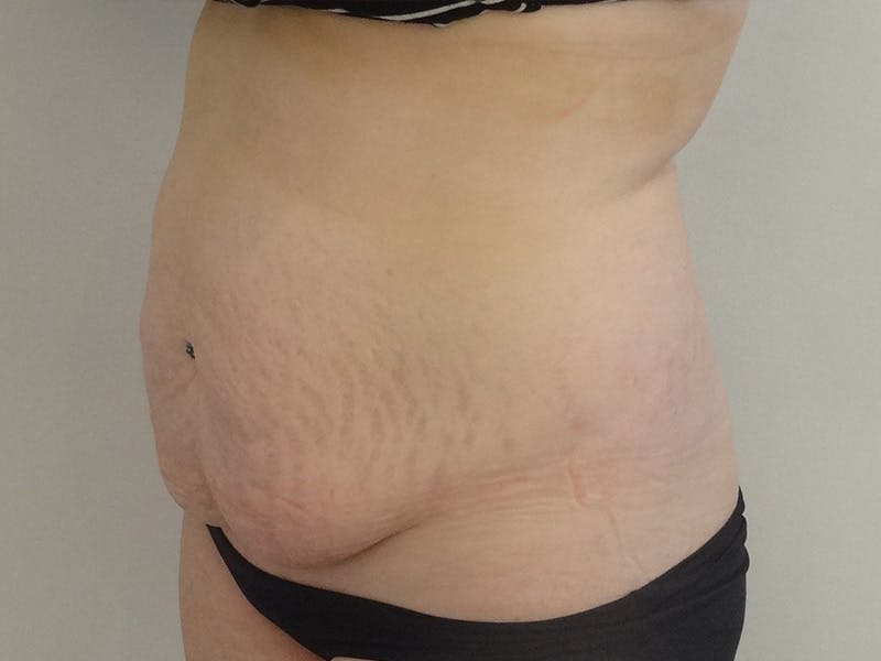 Tummy Tuck Before & After Gallery - Patient 114862 - Image 3