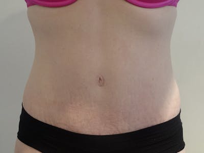 Tummy Tuck Before & After Gallery - Patient 114862 - Image 2