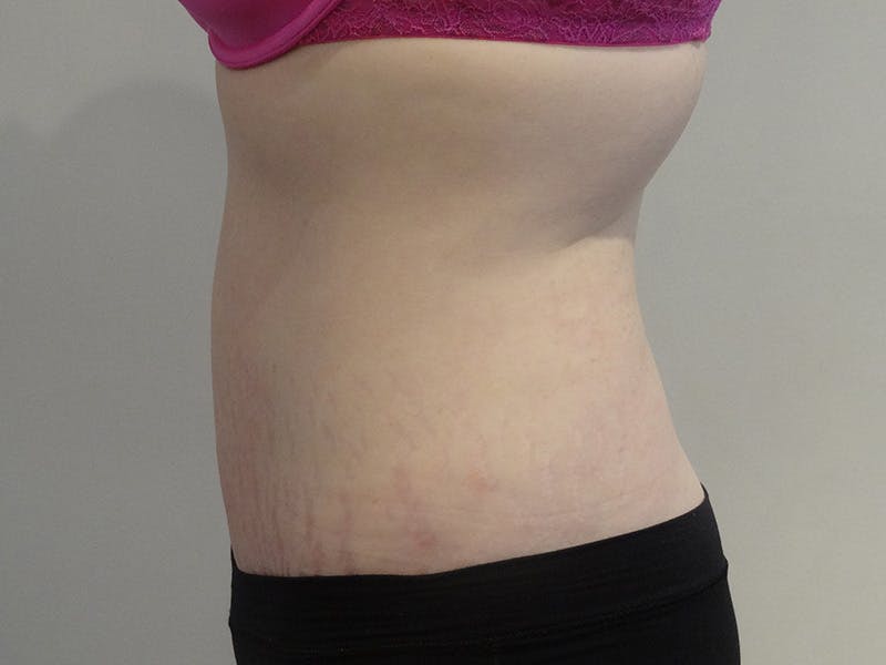 Tummy Tuck Before & After Gallery - Patient 114862 - Image 6