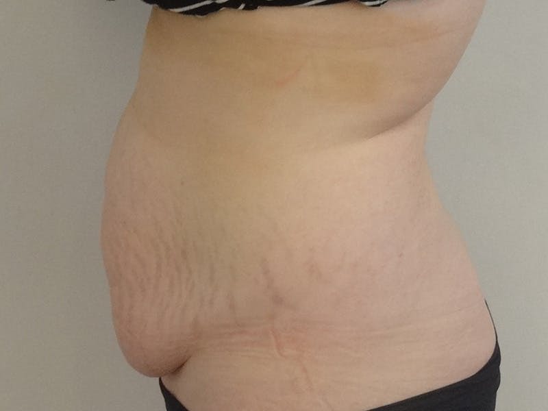 Tummy Tuck Before & After Gallery - Patient 114862 - Image 5