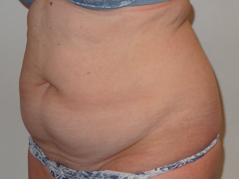 Tummy Tuck Before & After Gallery - Patient 371717 - Image 3