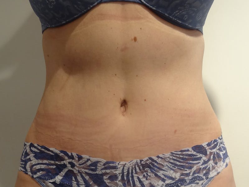 Tummy Tuck Before & After Gallery - Patient 371717 - Image 2