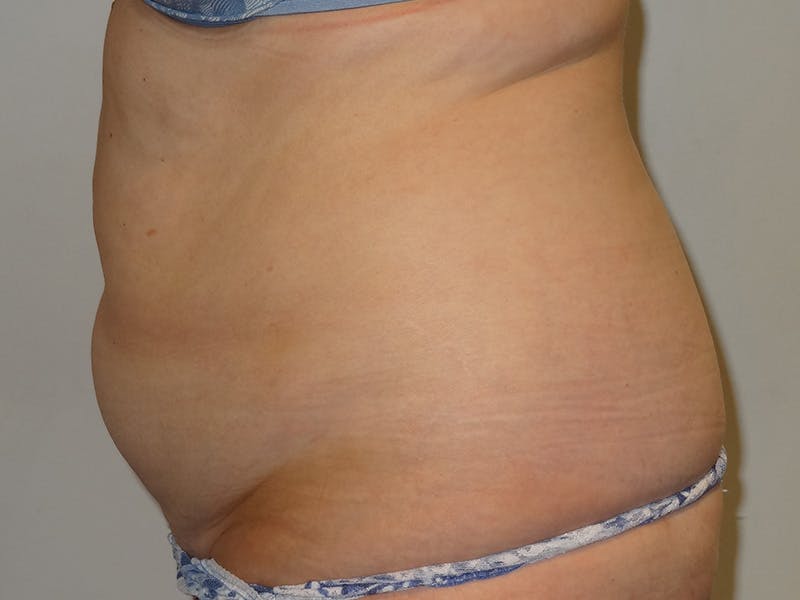 Tummy Tuck Before & After Gallery - Patient 371717 - Image 5