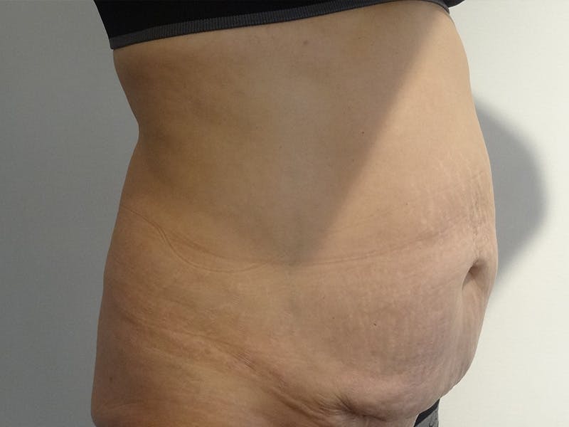 Tummy Tuck Before & After Gallery - Patient 266408 - Image 3