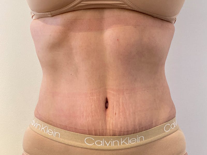 Tummy Tuck Before & After Gallery - Patient 266408 - Image 2