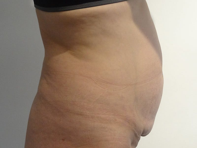Tummy Tuck Before & After Gallery - Patient 266408 - Image 5