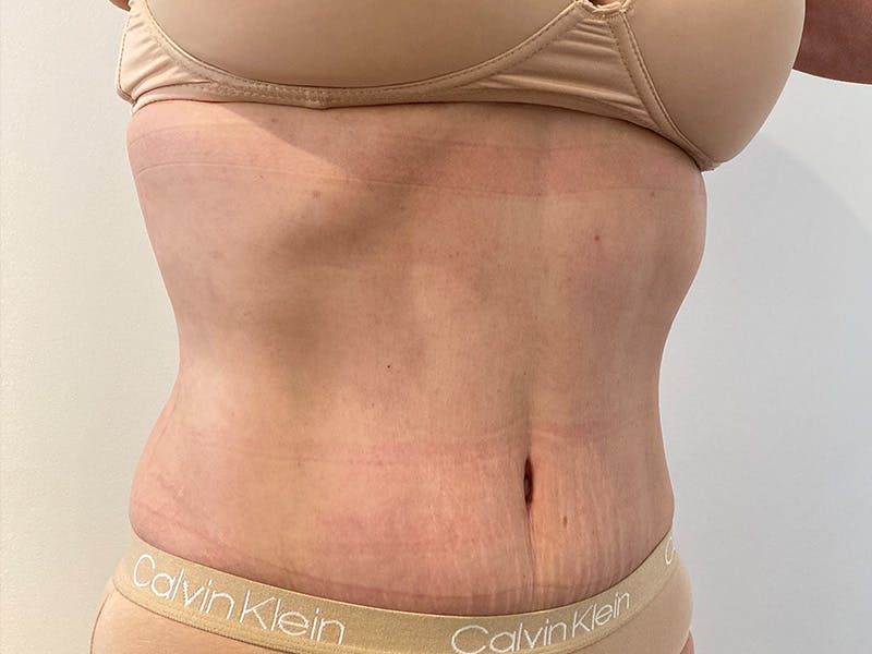 Tummy Tuck Before & After Gallery - Patient 266408 - Image 4