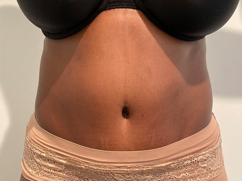 Tummy Tuck Before & After Gallery - Patient 334999 - Image 2