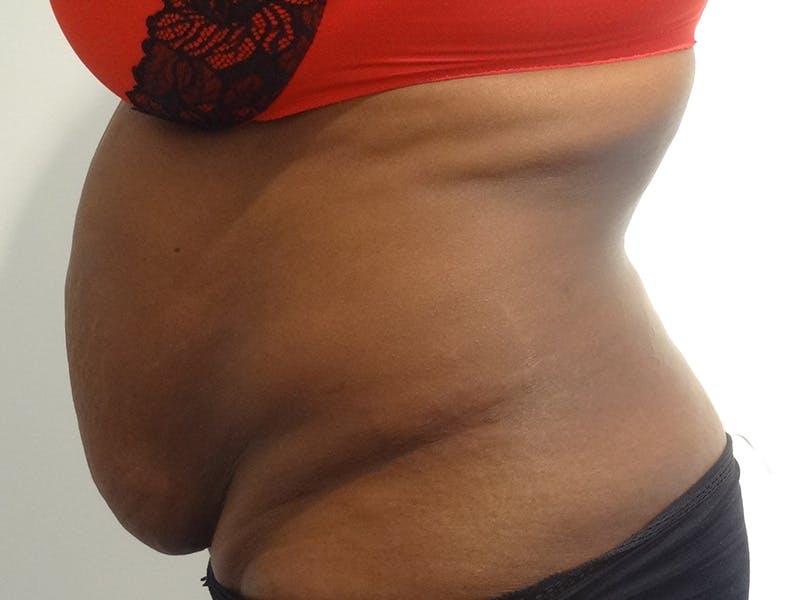 Tummy Tuck Before & After Gallery - Patient 334999 - Image 5