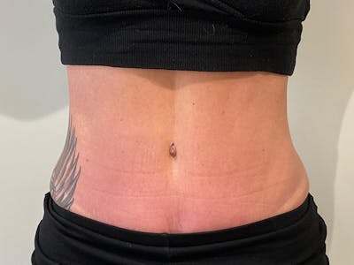 Tummy Tuck Before & After Gallery - Patient 310300 - Image 2