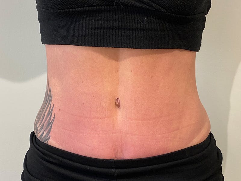 Tummy Tuck Before & After Gallery - Patient 310300 - Image 2