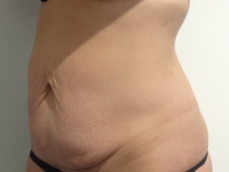 Tummy Tuck Before & After Gallery - Patient 310300 - Image 3