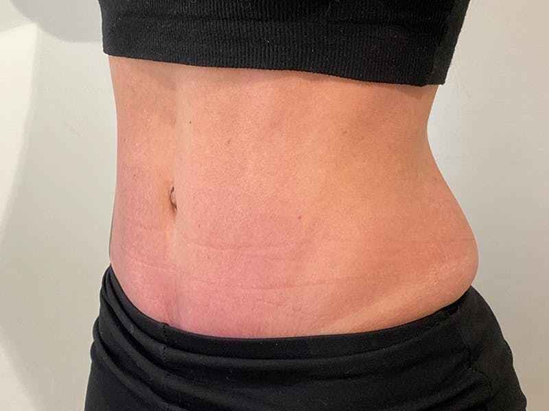 Tummy Tuck Before & After Gallery - Patient 310300 - Image 4