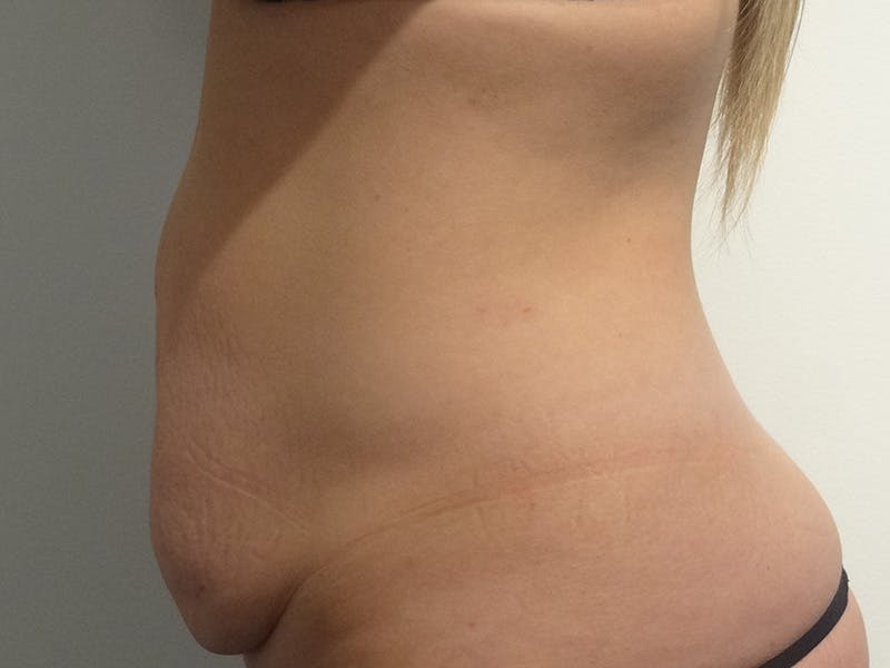 Tummy Tuck Before & After Gallery - Patient 310300 - Image 5