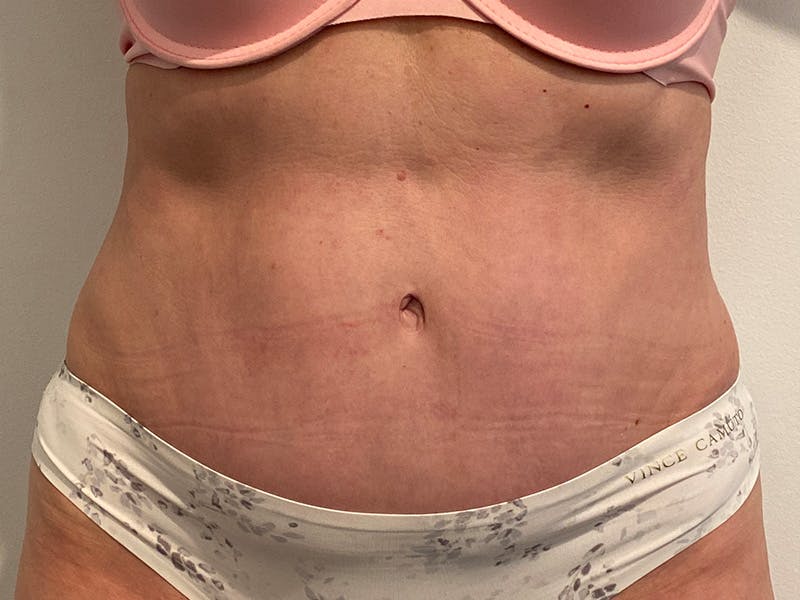 Tummy Tuck Before & After Gallery - Patient 715975 - Image 2