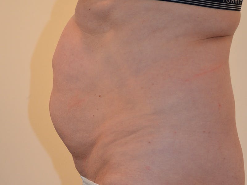 Tummy Tuck Before & After Gallery - Patient 715975 - Image 5