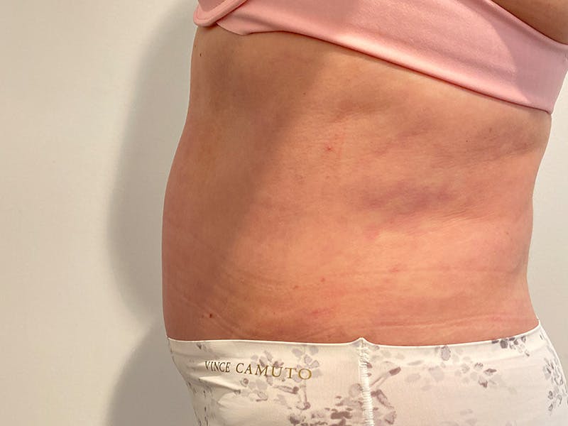 Tummy Tuck Before & After Gallery - Patient 715975 - Image 6