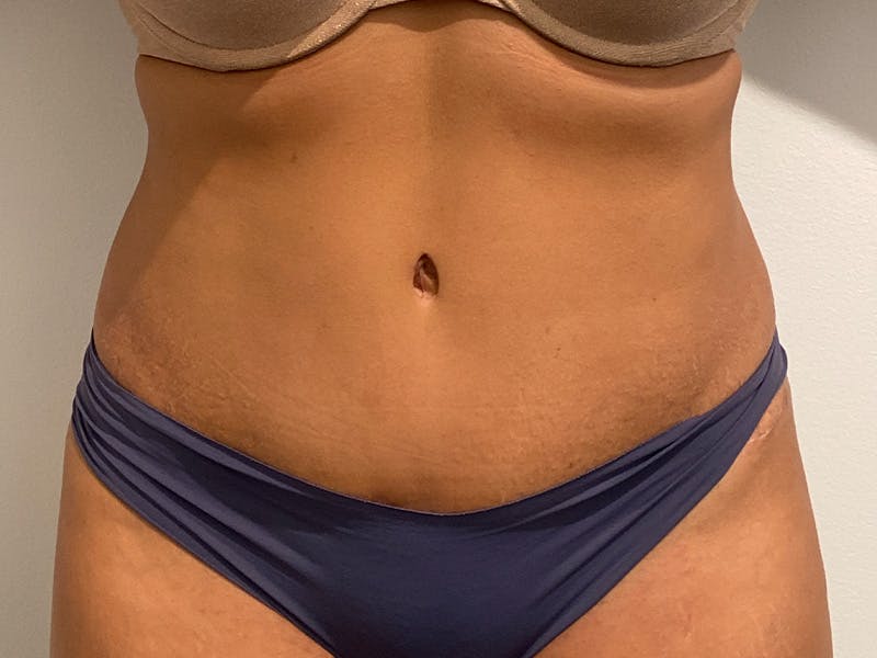 Tummy Tuck Before & After Gallery - Patient 971586 - Image 2