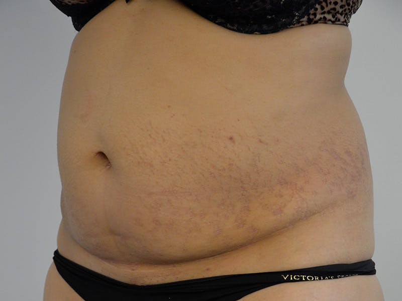 Tummy Tuck Before & After Gallery - Patient 971586 - Image 3