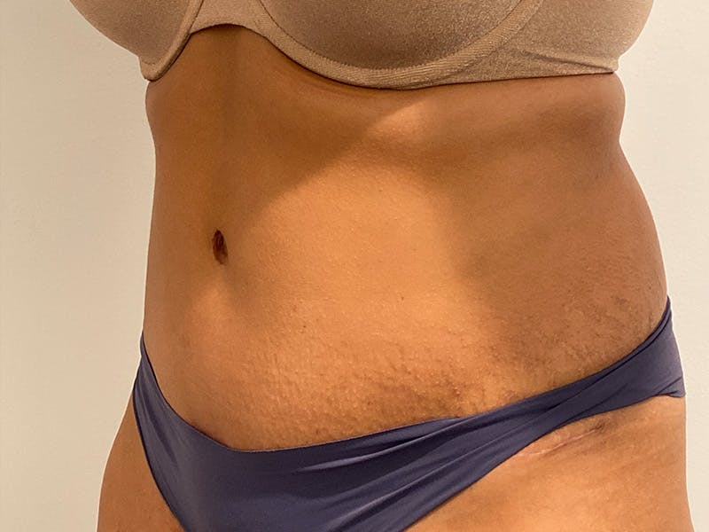 Tummy Tuck Before & After Gallery - Patient 971586 - Image 4