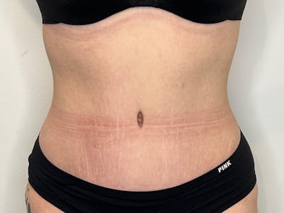 Tummy Tuck Before & After Gallery - Patient 436037 - Image 2