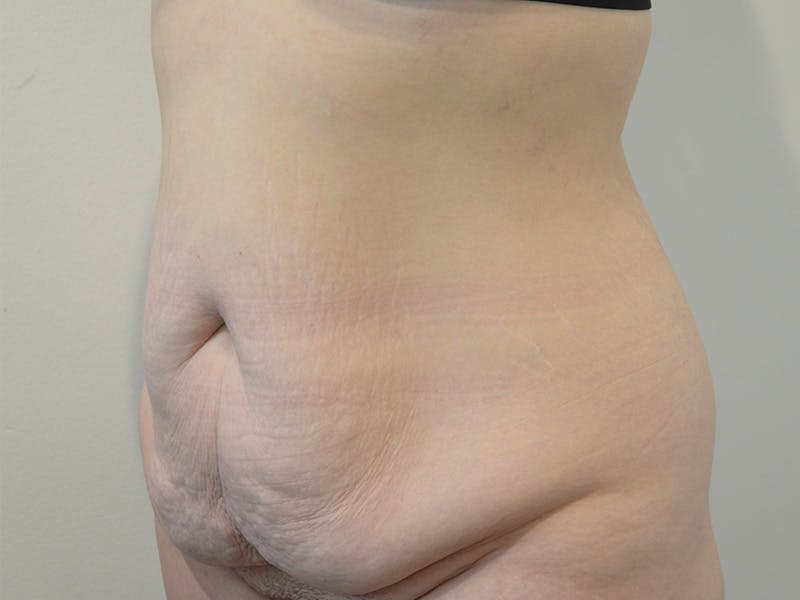 Tummy Tuck Before & After Gallery - Patient 436037 - Image 3