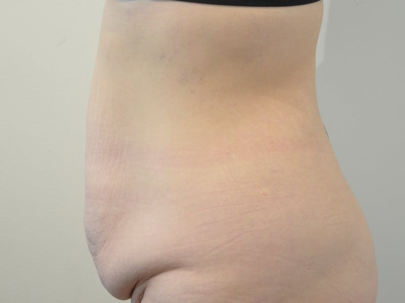Tummy Tuck Before & After Gallery - Patient 436037 - Image 5